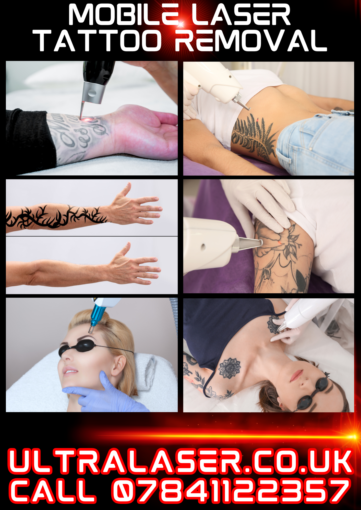 MOBILE LASER TATTOO REMOVAL LEICESTERSHIRE