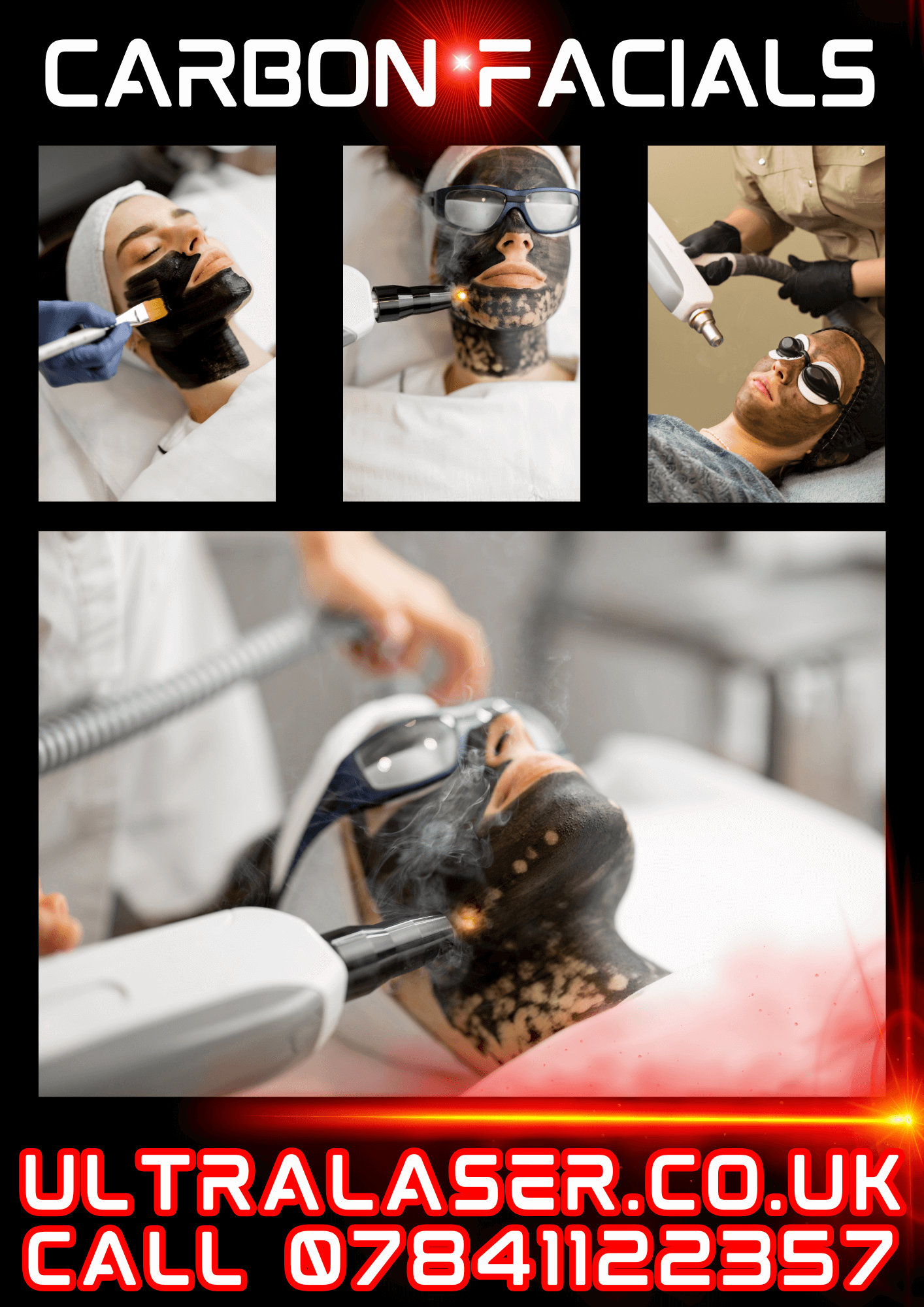 Mobile Carbon Facial Laser Treatment Leicester