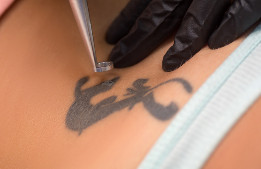 Mobile Tattoo Removal Nuneaton