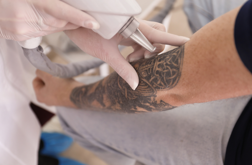 Mobile Tattoo Removal Tamworth