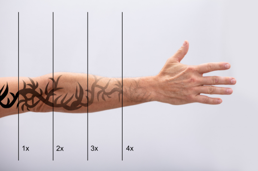 Mobile Tattoo Removal Hinckley