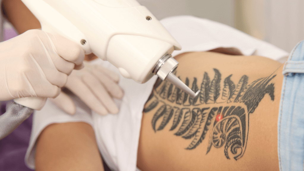 mobile tattoo removal leicester