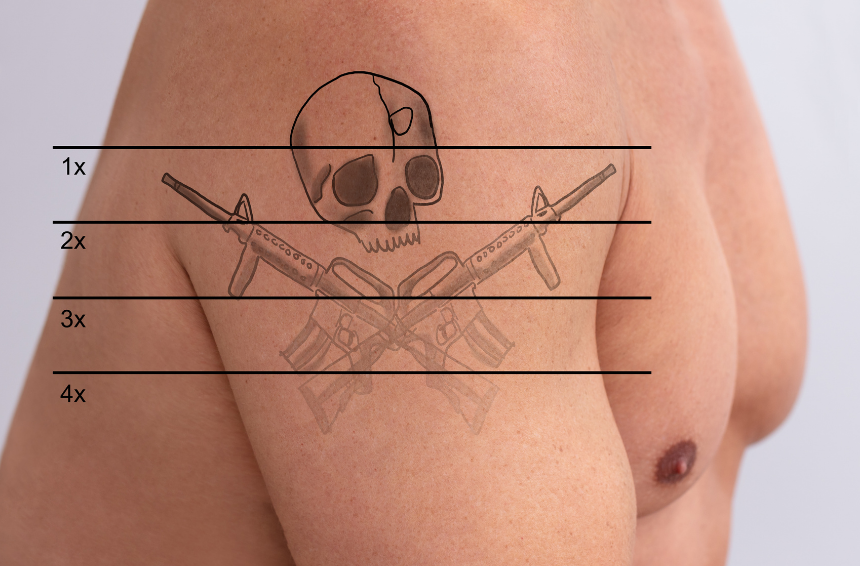 contact mobile laser tattoo removal leicester