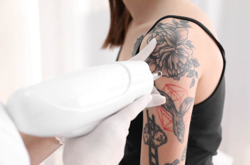 ultralaser mobile tattoo removal leicester 2