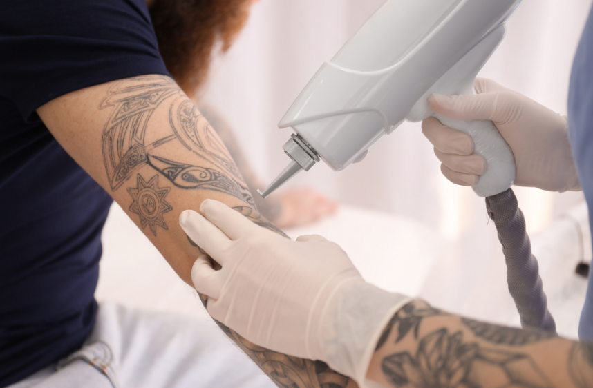 ultralaser mobile tattoo removal leicester 3